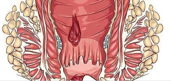 СИМПТОМЫ ПРИ ГЕМОРРОЕ